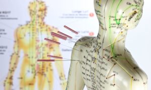 Acupuncture