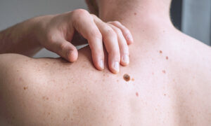 Melanoma