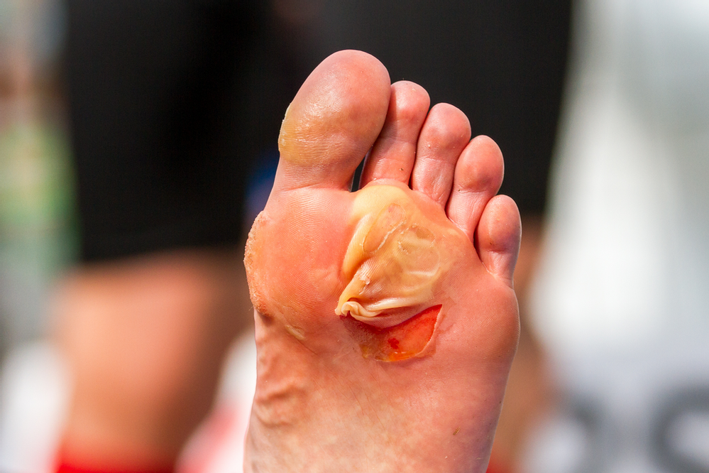 Blisters