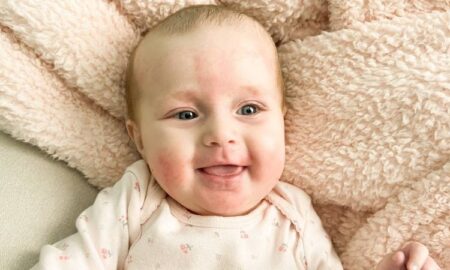 7 Ways to Calm Angry Eczema in Your Kids