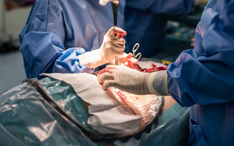C-Section