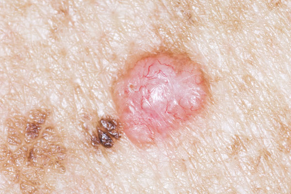 Pearly or Waxy Bump - Signs of Skin Cancer