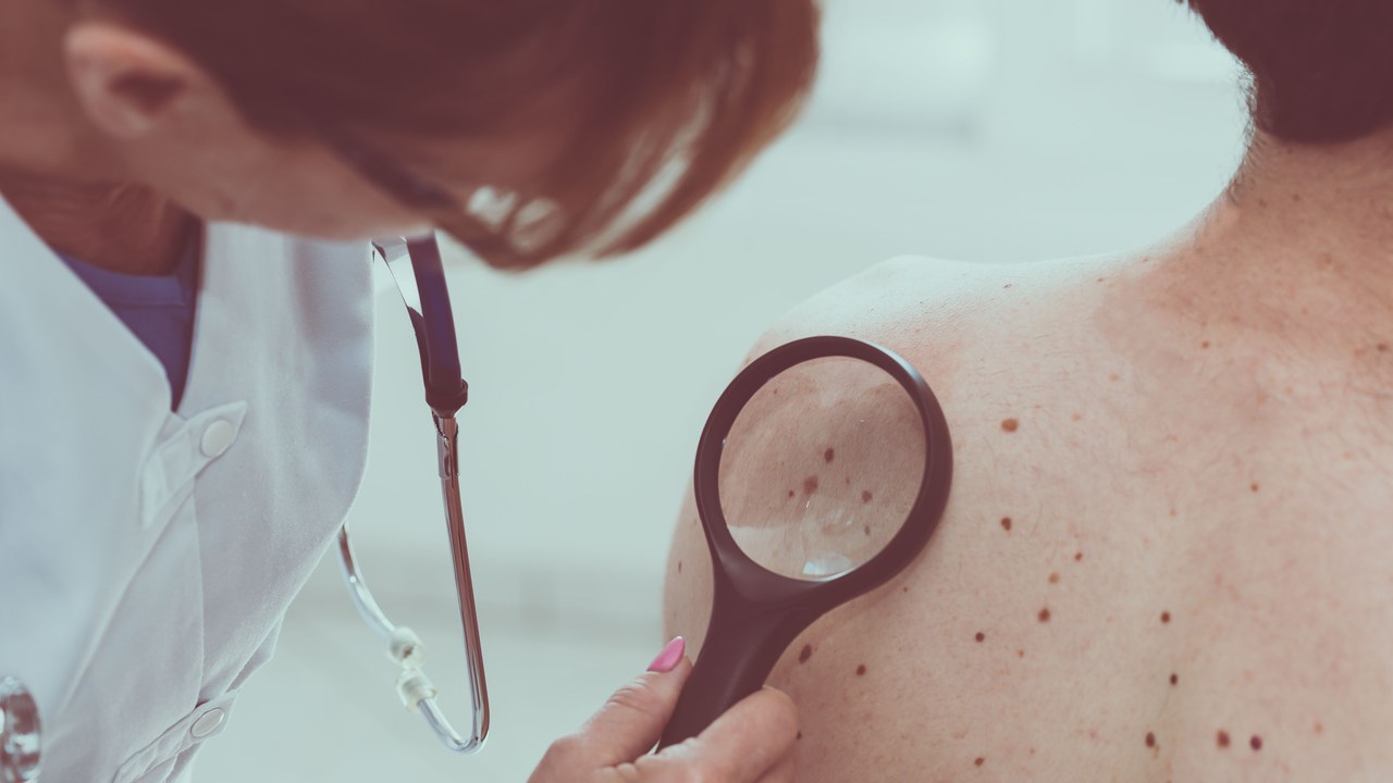 Deadly Symbols Of Skin Cancer You Must Spot Early