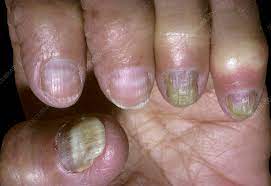 Overactive thyroid can contribute to the nails becoming brittle. 