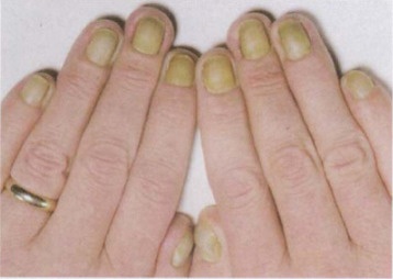 Yellow nails can develop in patients with chronic bronchitis and other diseases of lungs. 