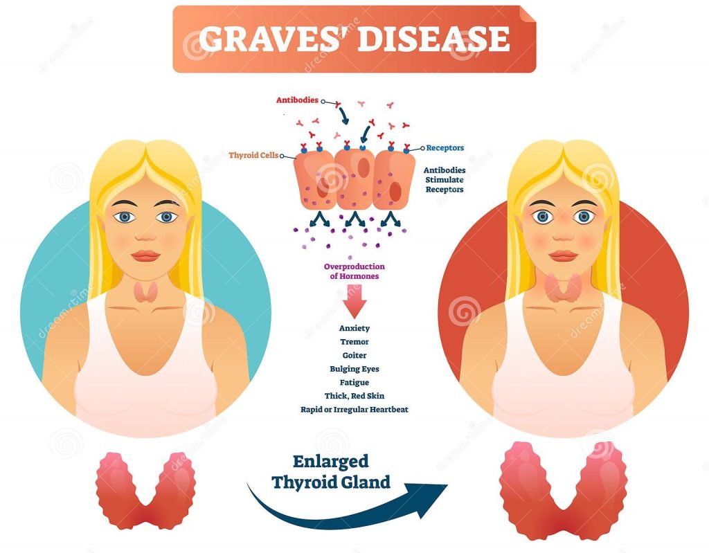 Thyroid disorders symptoms. Graves disease image.
