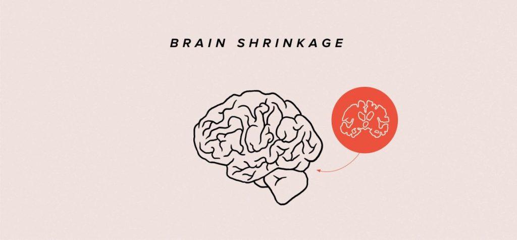Brain shrinking due to depression