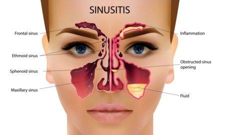 Sinus