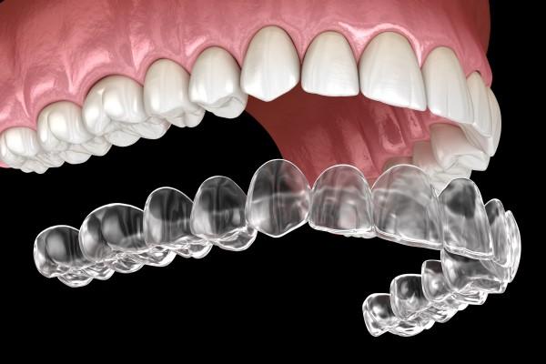 How clear aligner works