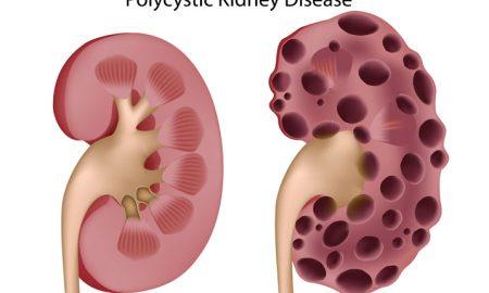 all about polycystic kidney