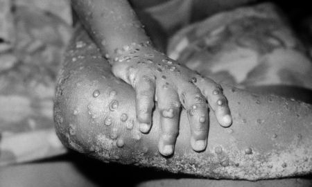 New Virus Outbreak: Is Monkeypox Dangerous?