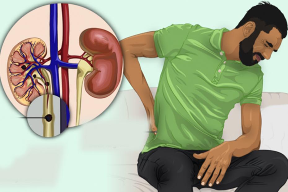 Consider ways to reduce the formation of kidney stones.