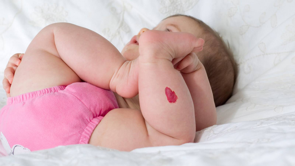 birthmarks