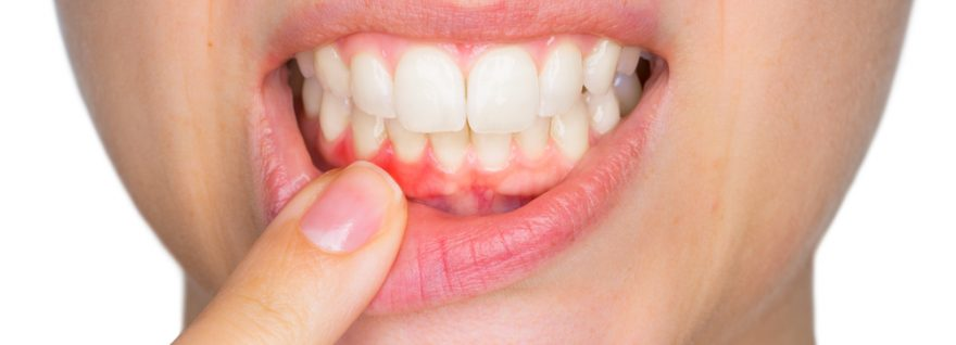 Gum disease